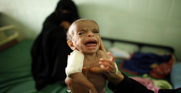 Médico segura bebê desnutrido em centro terapêutico do Yemen. Cerca de um milhão de crianças sofrem de desnutrição no país, devido aos altos preços dos alimentos