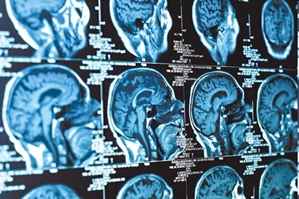 Ferramenta fundamental: imagens cada vez mais detalhadas do cérebro dão pistas do que ocorre, do ponto de vista fisiológico, com pacientes