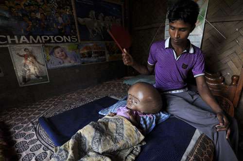 Roona Begum sofre de hidrocefalia, uma grave anomalia neurológica que é definida pelo aumento do volume do espaço contendo fluido cerebrospinal, o que provoca pressão sobre o cérebro