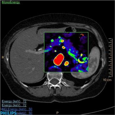 A imagem oferecida pela tomografia atual (E) é menos nítida. Já no resultado da tomografia espectral (D), as cores mostram ao médico com mais definição onde estão os tumores. O exame chegará ao Brasil em até dois anos