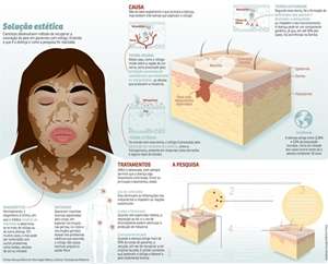 Cientistas descobrem método que reduz manchas brancas na pele 
