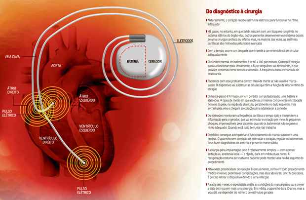 Confira o que muda na vida de quem tem marcapasso - Saúde