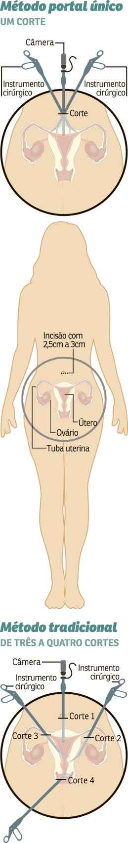 Médicos mineiros são pioneiros na laparoscopia na região pélvica