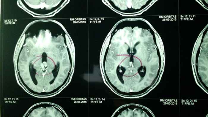 Ressonância magnética que mostra o tumor do estudante