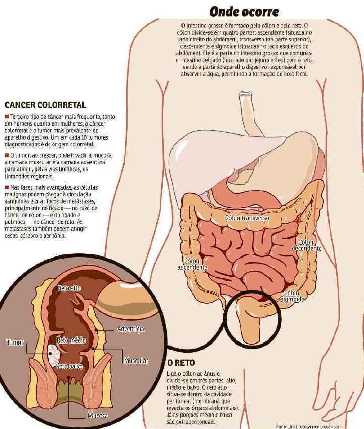 Câncer colorretal: sintomas são sangue nas fezes, cólicas e até fadiga