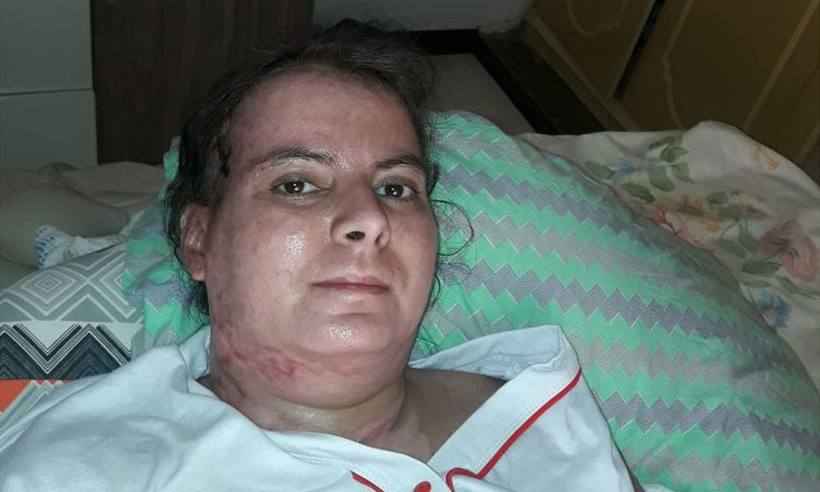 Professora Marley Simone Lima Antunes teve 40% do corpo queimado