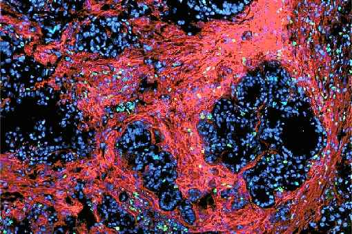 Microambiente de um tumor de pâncreas em um dos animais do estudo: células verdes, cancerosas, foram atacadas pela substância