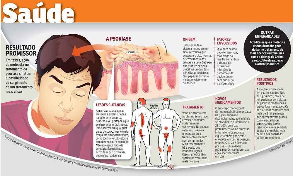 Infográfico sobre psoríase