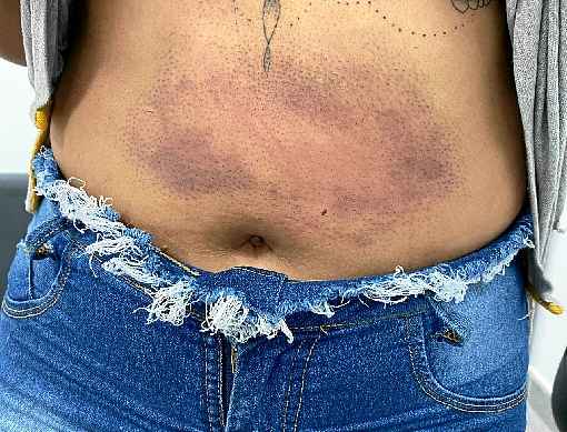 Jovem de 22 anos estÃ¡ com hematomas pelo corpo: agressÃµes diÃ¡rias desde dezembro