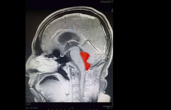 Os parasitas causavam incessantes dores de cabeÃ§a e vÃ´mitos no homem.