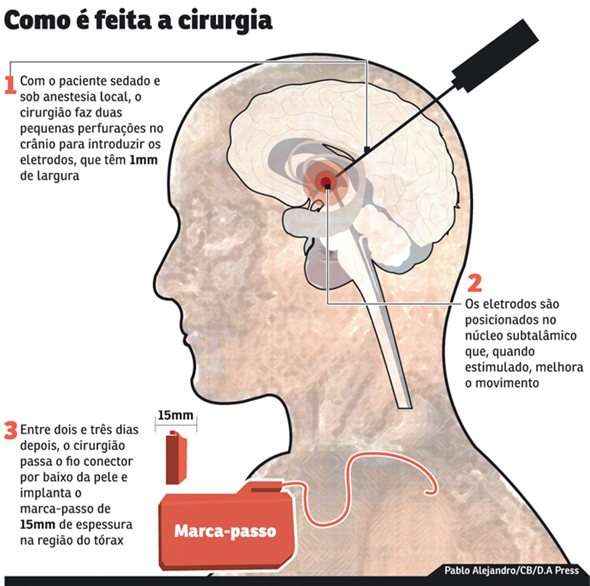 Procedimento tenta recriar a transmissão de sinais nos circuitos nervosos. Operação prevê a instalação de eletrodos no cérebro